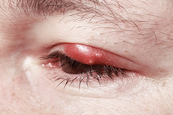 Silmäluomen tulehdus
