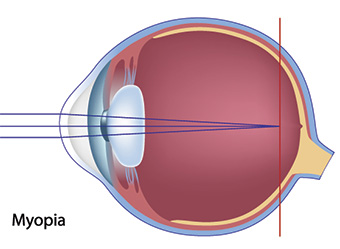 Myopia